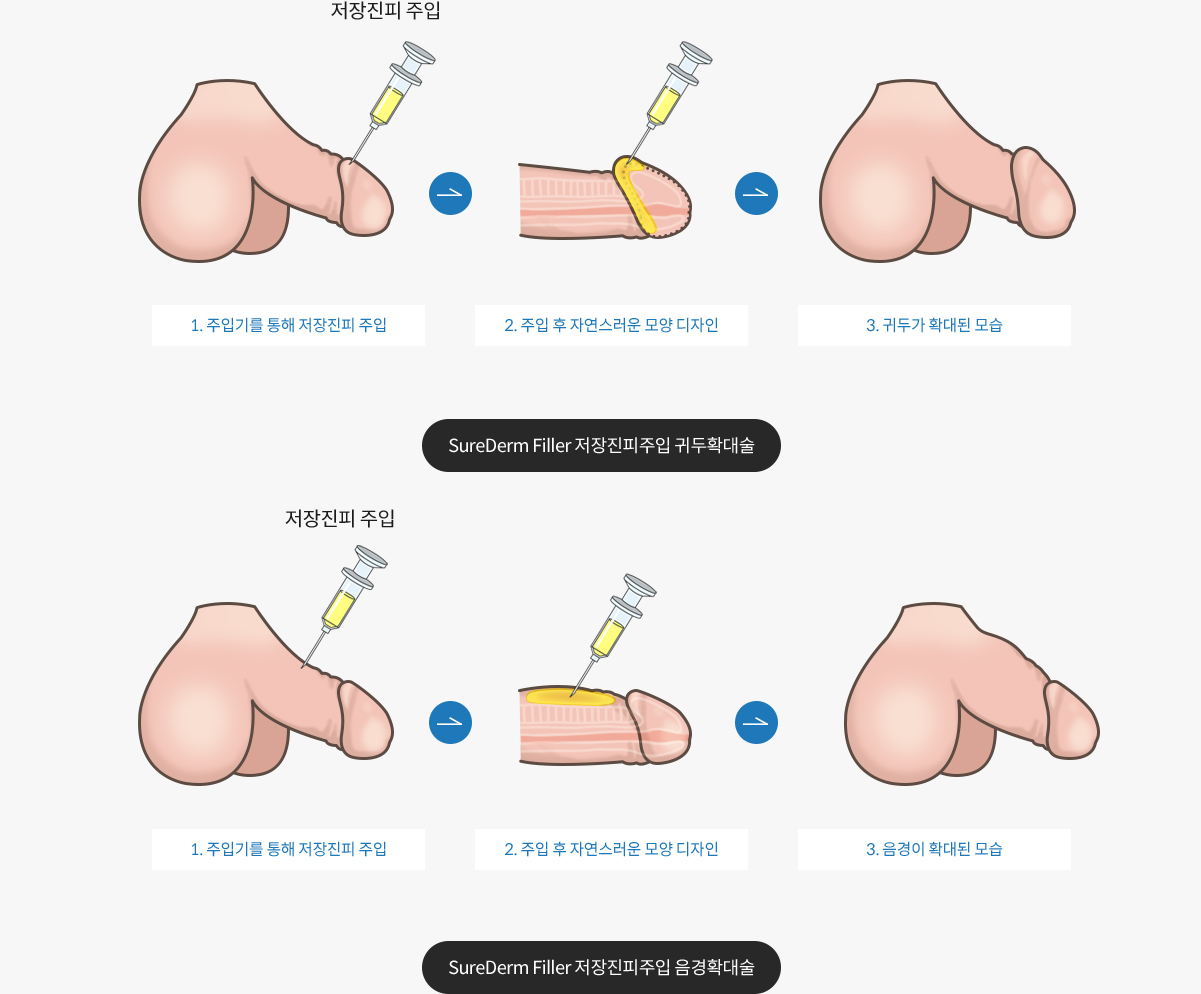 확대술