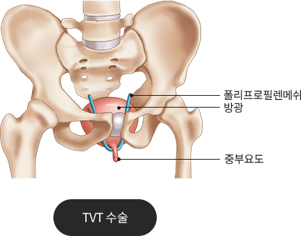 tvt수술