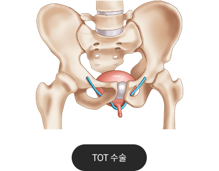 tot수술